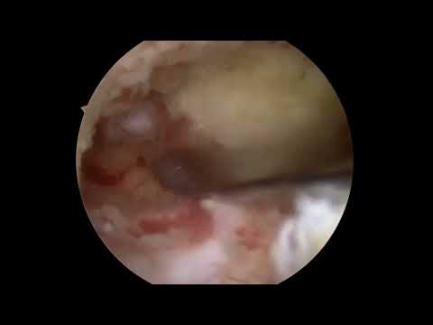 Lumbar Canal Stenosis treatment with endoscopy - Dr Shardul Soman