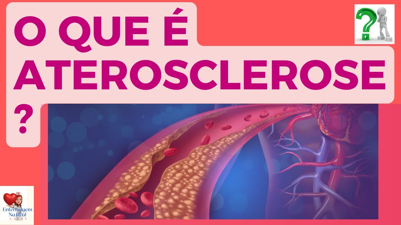 O QUE É ATEROSCLEROSE ? CAUSAS, TRATAMENTO, SINTOMAS E MUITO MAIS