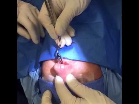 Nasal septoplasty 9