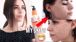 How I Cured My Dry Skin OVERNIGHT Using 1 Product!