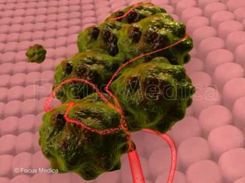 Ovarian cancer ESGO - Animated Atlas