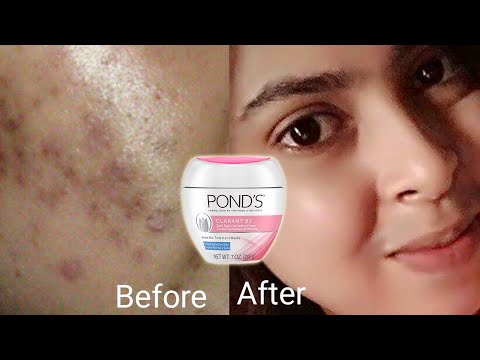 YouTube video about: Does pond's vanishing cream lighten skin?