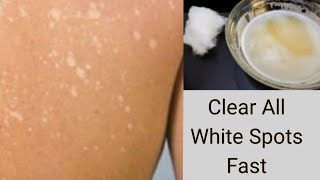 Apply This On Skin to Clear WHITE SPOTS | WHITE PATCHES VITILIGO | CREAM REACTION