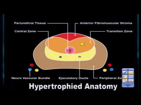 hogyan lehet megtudni hogy van- e prostatitis)