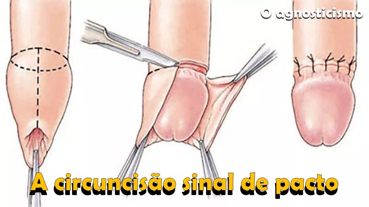 A CIRCUNCISÃO SINAL DE PACTO - Gênesis 17: 9 - 14