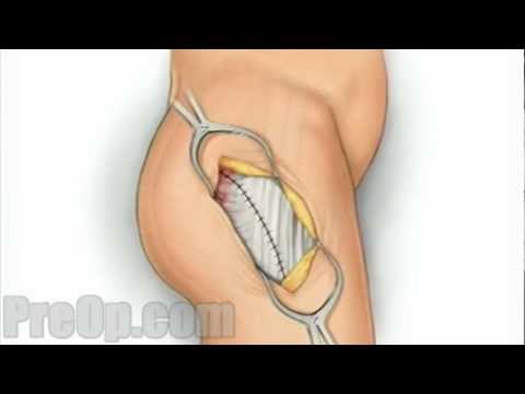 Hüftdysplasie bei einem Kind 3 Jahre der Behandlung Dr. Bubnovsky Gelenke Video