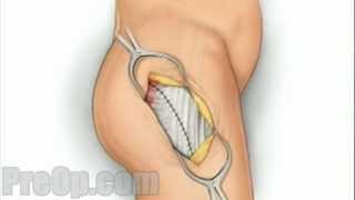 Hip Replacement Surgery - PreOp Patient Education Medical HD