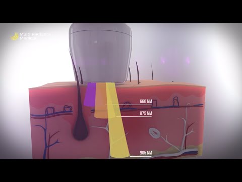 What is Super Pulsed Laser Therapy and How Does it Work? | Multi Radiance Medical