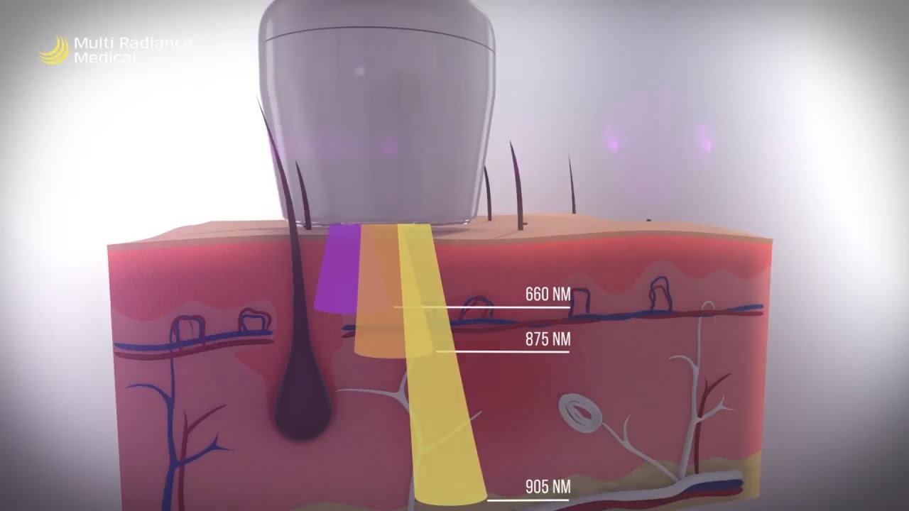 What is Super Pulsed Laser Therapy and How Does it Work? | Multi Radiance Medical
