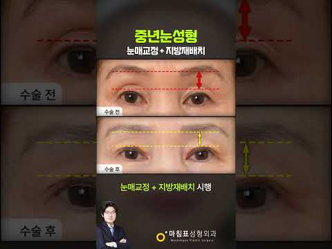 중년의 눈성형 · 韩语