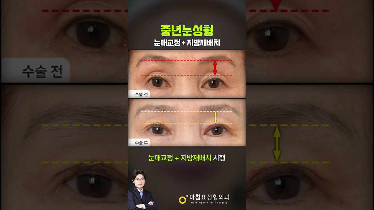 중년의 눈성형 썸네일 — 마침표성형외과 눈성형 영상