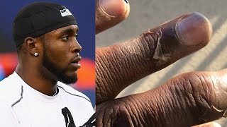 Kam Chancellor’s Frostbitten Fingers Look CRAZY!