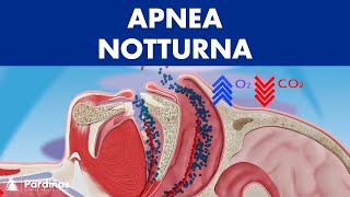 Apnea notturna ©