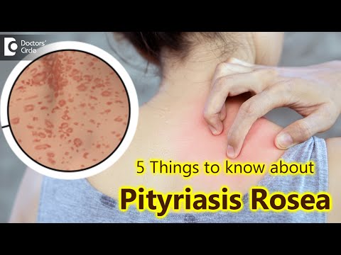 5 Things to know about Pityriasis Rosea | Pityriasis Rosea Rash - Dr. Divya Sharma|Doctors' Circle