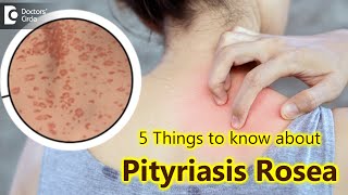 5 Things to know about Pityriasis Rosea | Pityriasis Rosea Rash - Dr. Divya Sharma|Doctors