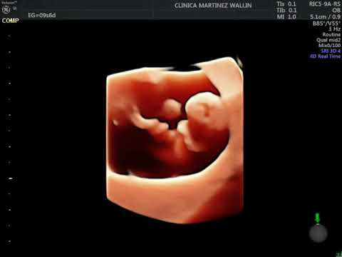 Ecografía 5D 10 semanas de embarazo