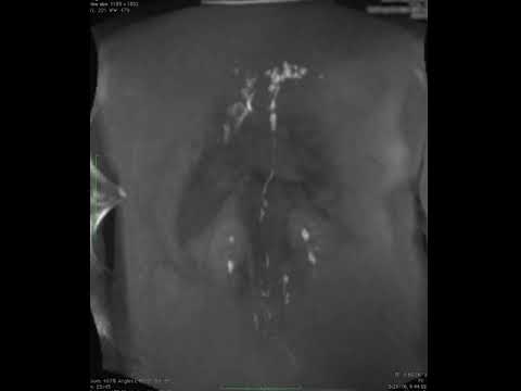 Watch video titled MRI with contrast for chylothorax on YouTube
