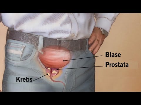 Prostatitis vomot
