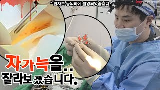 #자가늑 잘라보았습니다... ???? #아이루미성형외과 #코성형