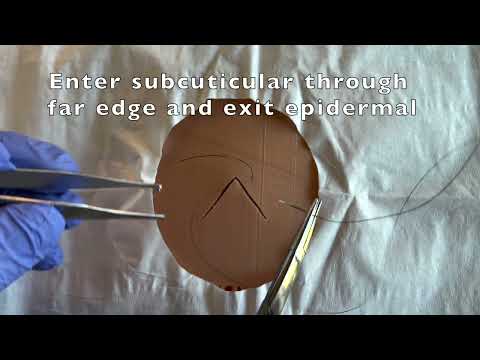 The "V" corner stitch for traumatic lacerations.