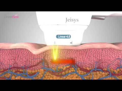 ULTRAcel Q+ linear-shot HIFU treatment (LinearFirm)