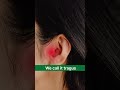 Relieve Tinnitus Ringing Sound With This Acupressure Point Ear Problem Hearing Problem Shorts