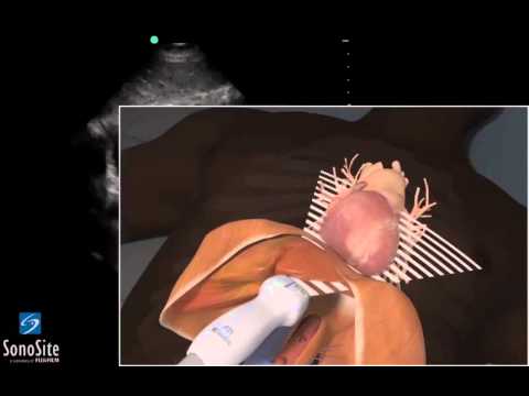 3D Lehrvideo: EFAST - Subxiphoid