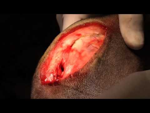 Bovie® Animal Health – Tibial Plateau Leveling Osteotomy (TPLO)