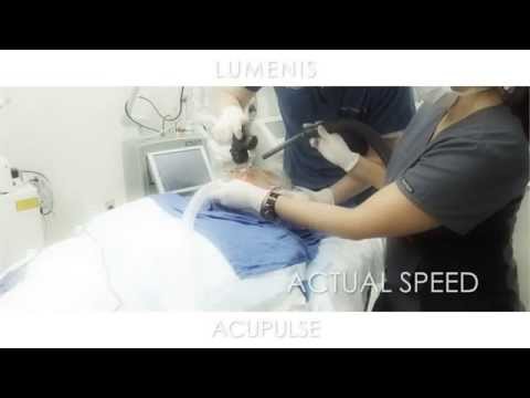 AcuPulse - Procedure Video | Lumenis