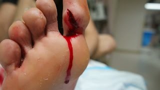 GOT HURT HAD TO GET STITCHES IN MY TOE!