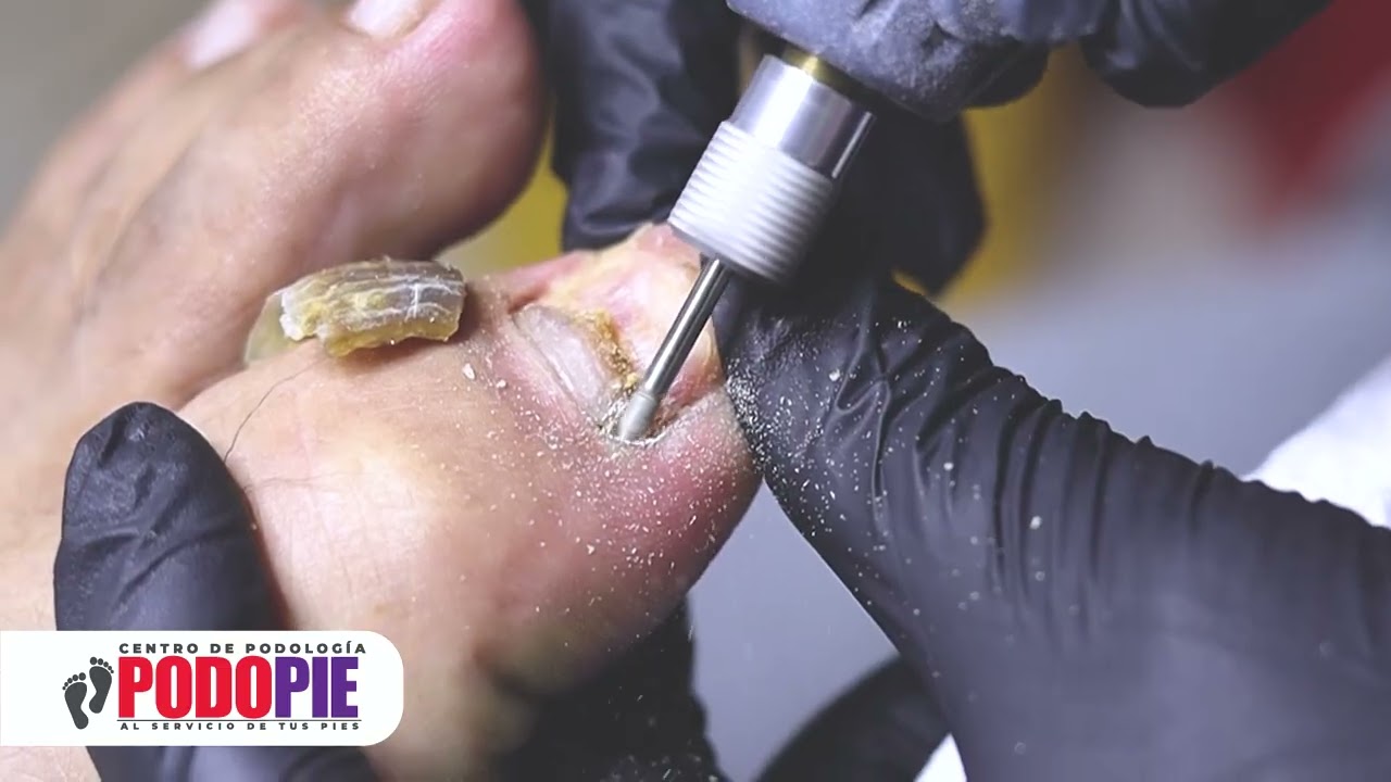 EXTRACCIÓN DE UÑA con HONGOS Onicomicosis
