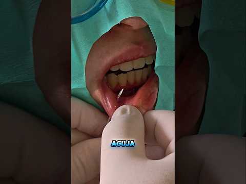 Helix Piercing con Aplicador