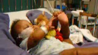 Preemie CJ Colostomy Free at Last