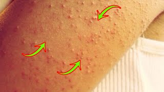 DO YOU HAVE THESE LITTLE BUMPS ON THE ARMS? SEE WHY THEY COME OUT AND HOW TO REMOVE THEM