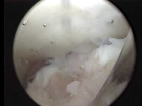 Segni di artrosi deformante del ginocchio sinistro di 1 grado Come un gel applicato sul ginocchio