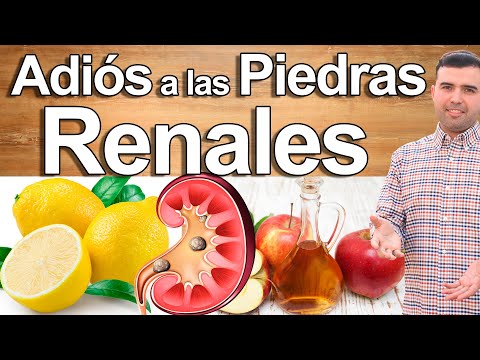 How to Remove Kidney Stones - Never Again