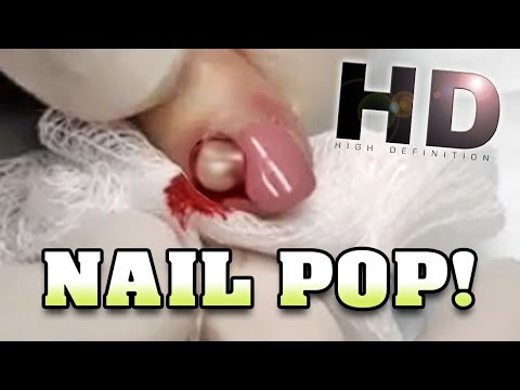 Halamang-singaw sa kuko ng kamay paunang paggamot Halamang-singaw sa pagitan ng toes review