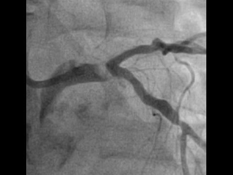 CABG or PCI for this left main NSTEMI?
