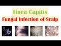 Fungal Infection of the Scalp (Tinea Capitis) | Causes, Risk Factors, Symptoms, Diagnosis, Treatment
