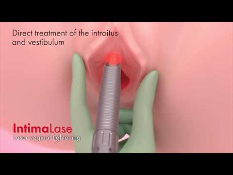 Zpevnění pochvy   laserová rejuvenace