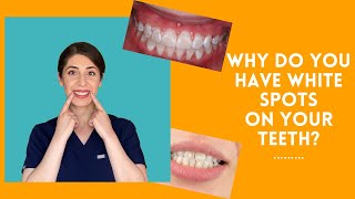WHAT ARE THE WHITE SPOTS ON YOUR TEETH?