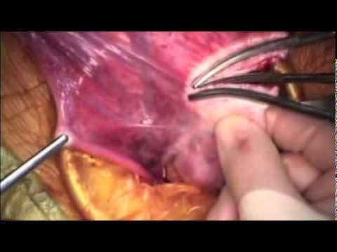 Ovarian Cyst Removal Using a Small Suprapubic Incision