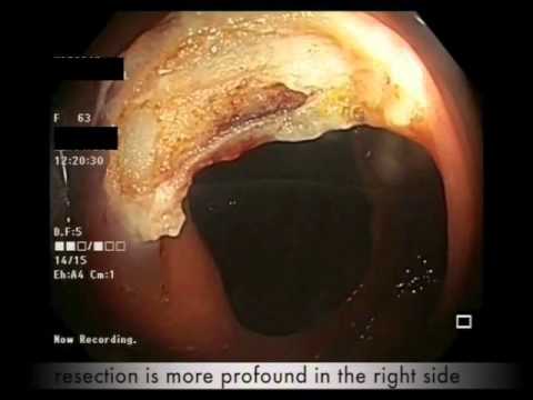 Resection of an Ileocecal Polyp