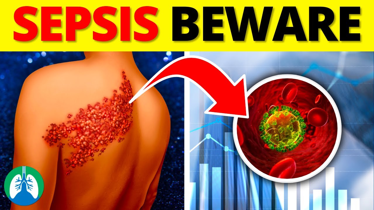 Sepsis Cases Are On the Rise | Beware of This Infection
