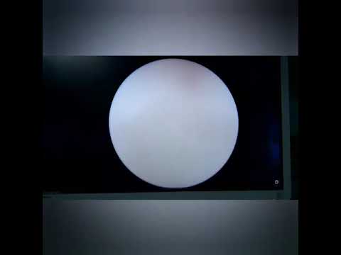 Laser Stone Dusting | Dr Samarth Agarwal - Best Urologist in Siliguri