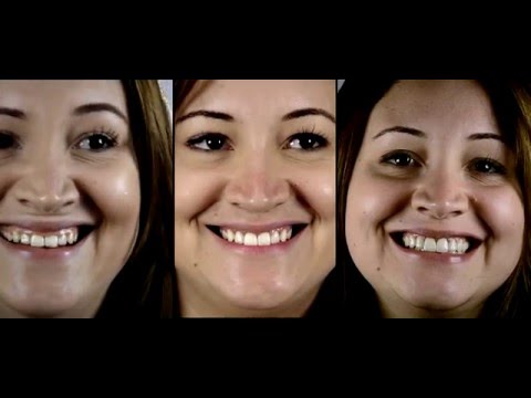 DENTATE - Plástica Gengival e Lente de Contato Dental