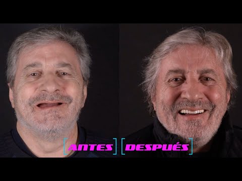 ORION DENTAL: DIENTES FIJOS EN UN DIA