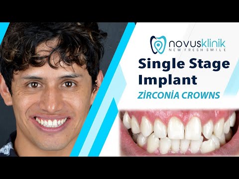 Single-Stage Dental Implant & Zirconium Crown in Turkey: Julian’s Treatment Journey
