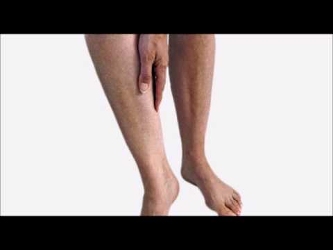 Varice profonde Varice profonde