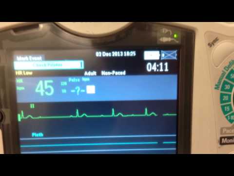 Second degree versus third degree heart blocks